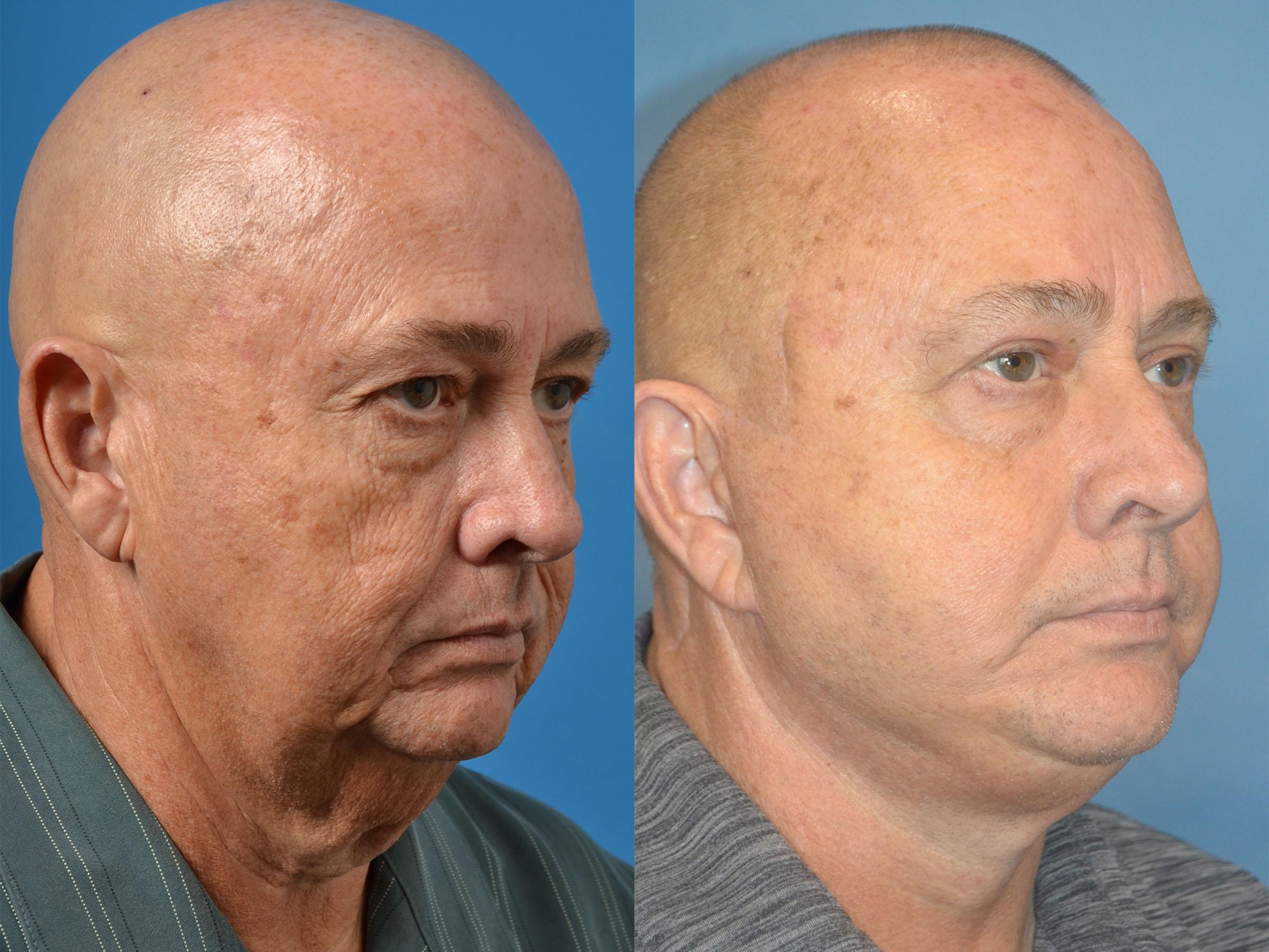 Male Facelift Photos Melbourne, FL Patient 56595